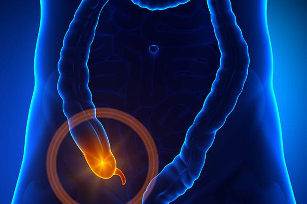 Illustration of an inflamed appendix