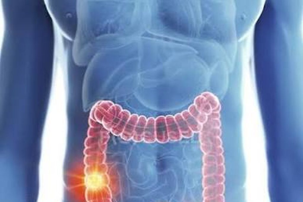Illustration of the colon highlighted in the abdomen