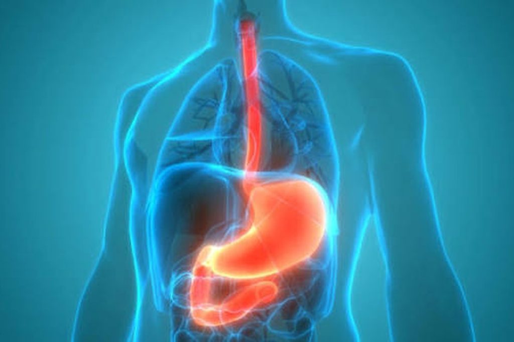 Illustration of a hiatal hernia with the stomach highlighted