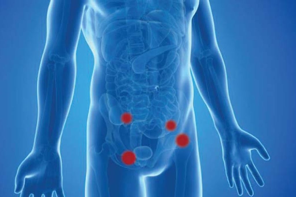 Illustration showing inguinal hernia sites in the lower abdomen